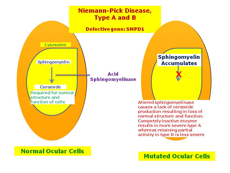 NiemannPick Disease, Types A and B Hereditary Ocular Diseases
